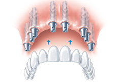 Implantat